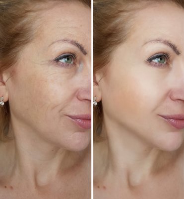 Face,Woman,Wrinkles,Before,And,After,Treatments